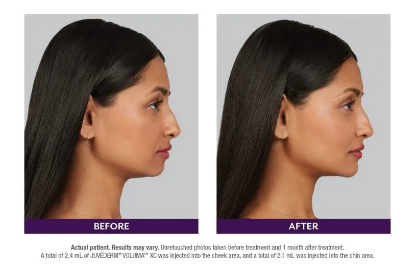 Juvederm before and after case example