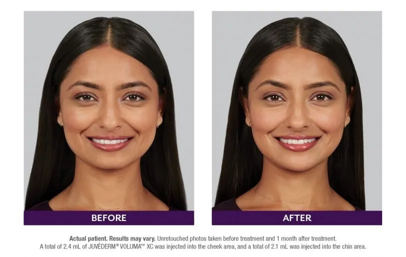 Juvederm before and after case example